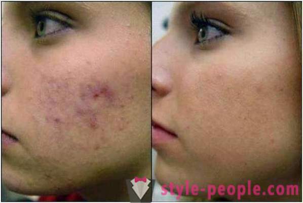 Azelainsyre peelinger: anmeldelser kosmetologer, fotos før og efter