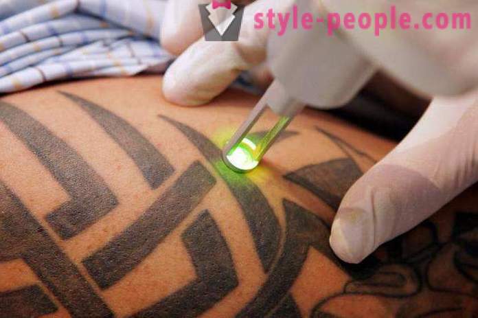 Laser tatovering fjernelse. Anmeldt af