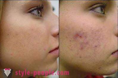 Vil du vide, hvordan du fjerner spor af bumser på dit ansigt?