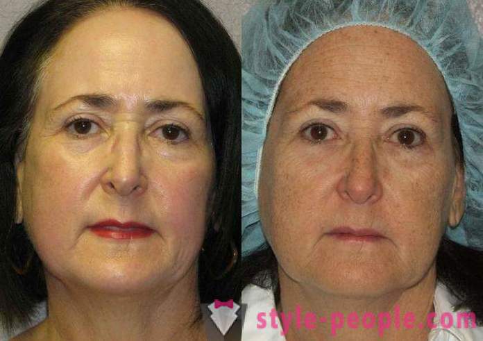 Laserbehandling af ansigtet - en sikker måde at forynge